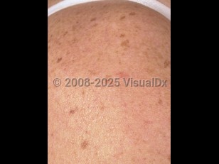 Familial leiomyomatosis cutis et uteri