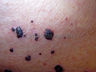Bullous hemorrhagic dermatosis