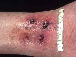 Ischemic ulcer