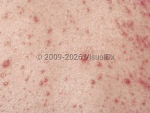 Neutrophilic eccrine hidradenitis