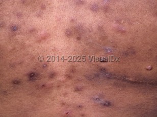 Eosinophilic folliculitis