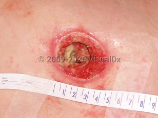 Pressure injury