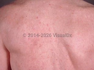 Clinical image of Transient acantholytic dermatosis - imageId=398692. Click to open in gallery.  caption: 'Scattered light pink papules on the upper back.'