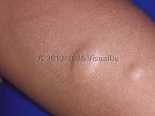 Anetoderma