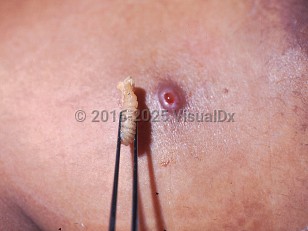 Clinical image of Myiasis - imageId=402355. Click to open in gallery.  caption: 'A close-up of a glistening pink and brown papule with a central cavity and the extracted larva of <i>Wohlfahrtia</i><i> vigil</i>.'