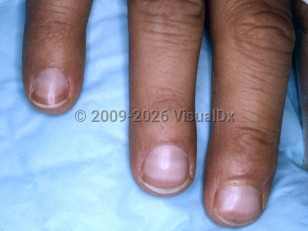 Terry nails
