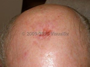 Erosive pustular dermatosis