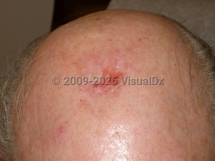 Erosive pustular dermatosis