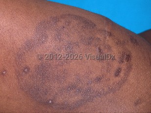 Tinea corporis