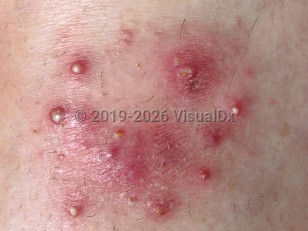 Majocchi granuloma