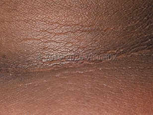 Clinical image of Acanthosis nigricans - imageId=40959. Click to open in gallery.  caption: 'Acanthotic, thickened, ridged, and hyperpigmented plaques on the posterior neck.'