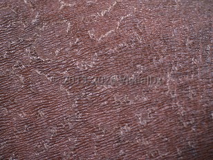 Tinea imbricata