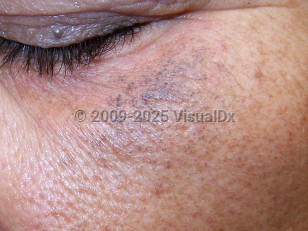 Clinical image of Exogenous ochronosis - imageId=4146481. Click to open in gallery. 