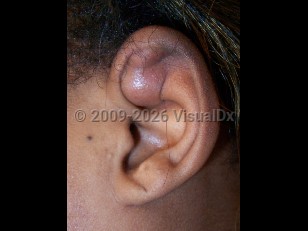 Pseudocyst of auricle
