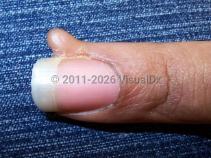 Acquired digital fibrokeratoma