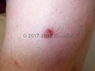 Clinical image of Amelanotic melanoma - imageId=4158614. Click to open in gallery.  caption: 'An amelanotic melanoma showing a pink eroded papule on the arm.'