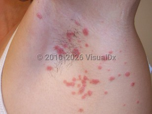 Guttate psoriasis
