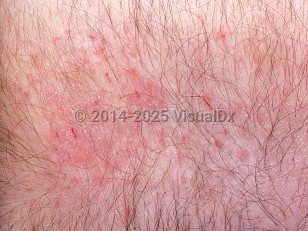 Clinical image of Pruritus of senescence - imageId=417077. Click to open in gallery.  caption: 'Cracked, scaly, erythematous papules and plaques (eczema) occuring secondary to xerosis.'