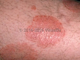 Large plaque parapsoriasis