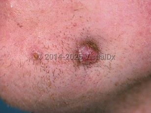 Clinical image of Cutaneous dental sinus tract - imageId=423132. Click to open in gallery.  caption: 'A reddish nodule with scant overlying scale and surrounding crusting, and a similar papule, on the lateral chin.'