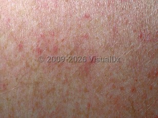 Clinical image of Dengue fever - imageId=423445. Click to open in gallery.  caption: 'A close-up of erythematous macules and papules.'
