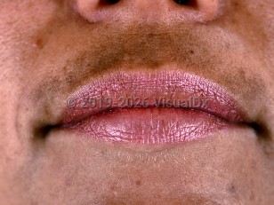 Melasma