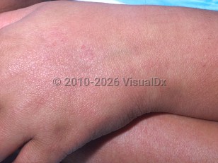 Scarlet fever