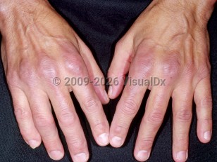 Clinical image of Rheumatoid arthritis - imageId=4267555. Click to open in gallery.  caption: 'Violaceous patches over the Metacarpophalangeals (MCP) and dorsal fingers in a patient with morphea.&nbsp;'