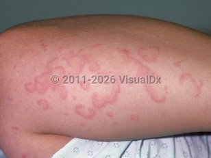 Urticarial vasculitis