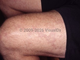 Clinical image of Sneddon syndrome - imageId=4342337. Click to open in gallery.  caption: 'Dusky retiform patches (livedo racemosa) on the&nbsp;thigh.'