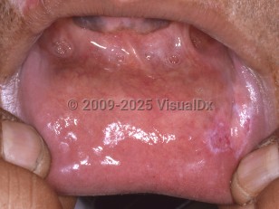 Oral lupus erythematosus