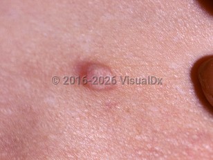 Granular cell myoblastoma of vulva