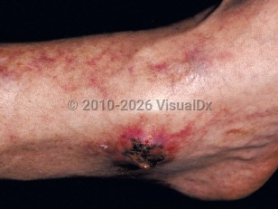 Cryoglobulinemia