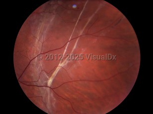 Retinal detachment