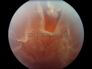 Retinal tear