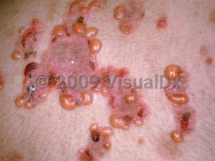 Linear IgA bullous dermatosis