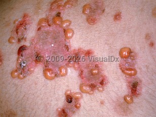 Linear IgA bullous dermatosis