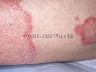 Clinical image of Pustular psoriasis - imageId=4406336. Click to open in gallery.  caption: 'A close-up of well-demarcated, erythematous plaques with peripherally accentuated scale.'