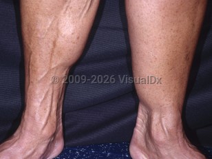 Lipoatrophy