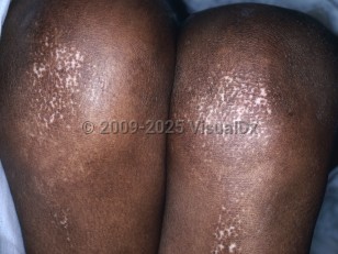 Sclerodermatomyositis