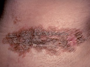 Granular parakeratosis