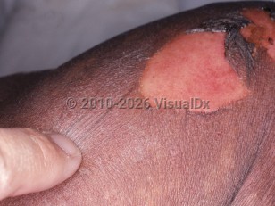 Toxic epidermal necrolysis