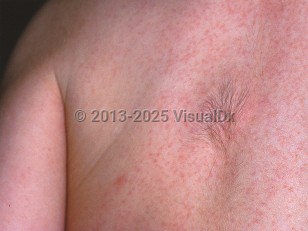 Clinical image of Fibrous hamartoma of infancy - imageId=457780. Click to open in gallery.  caption: 'A hypertrichotic patch on the back. Note also the unrelated erythematous papules (possible miliaria rubra).'