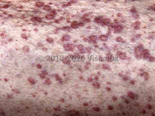 Multiple myeloma