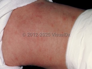 Clinical image of Subcutaneous fat necrosis of the newborn - imageId=46236. Click to open in gallery.  caption: 'Erythematous papules and plaques on the back of a neonate.'