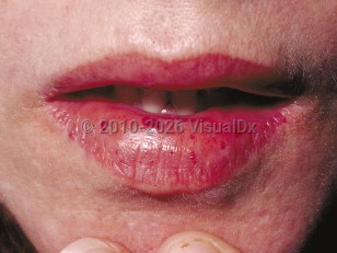 Hereditary hemorrhagic telangiectasia