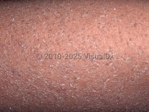 Clinical image of Xerosis - imageId=4685954. Click to open in gallery.  caption: 'A close-up of diffuse scaling.'