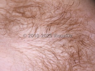 Clinical image of Black piedra - imageId=4717788. Click to open in gallery.  caption: 'A close-up of adherent black concretions around terminal hairs.'