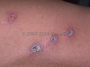 Histoplasmosis