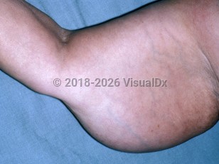 Clinical image of Adiposis dolorosa - imageId=4770864. Click to open in gallery.  caption: 'A large subcutaneous tumor on the upper arm.'
